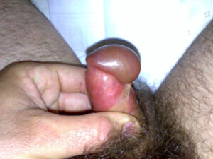 frenulo
